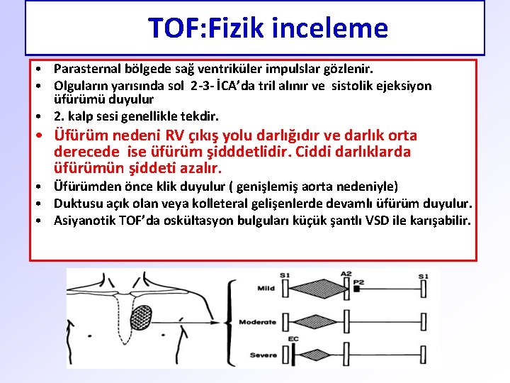 TOF: Fizik inceleme • Parasternal bölgede sağ ventriküler impulslar gözlenir. • Olguların yarısında sol