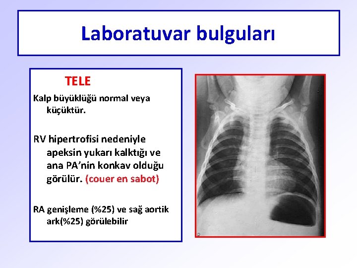 Laboratuvar bulguları TELE Kalp büyüklüğü normal veya küçüktür. RV hipertrofisi nedeniyle apeksin yukarı kalktığı