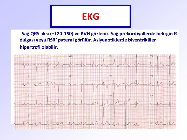 EKG Sağ QRS aksı (+120 -150) ve RVH gözlenir. Sağ prekordiyallerde belirgin R dalgası