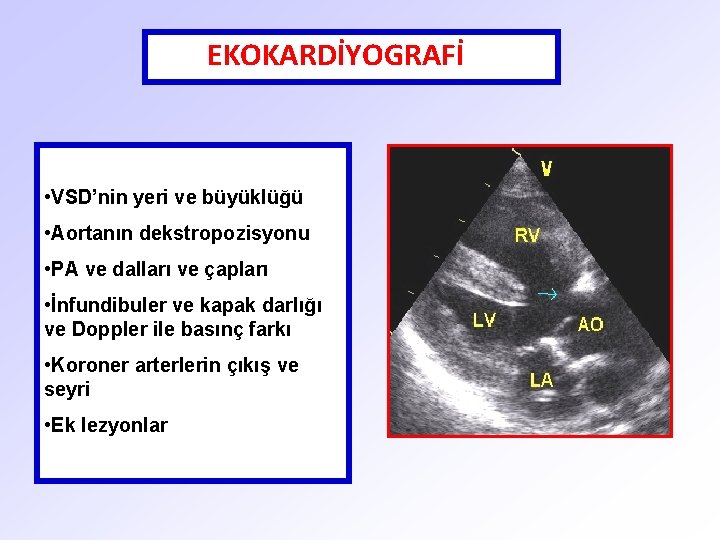 EKOKARDİYOGRAFİ • VSD’nin yeri ve büyüklüğü • Aortanın dekstropozisyonu • PA ve dalları ve