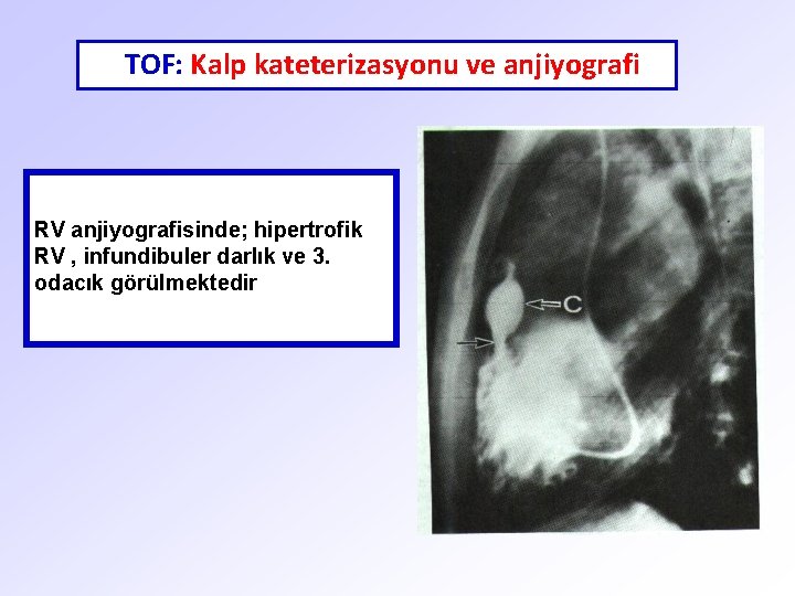 TOF: Kalp kateterizasyonu ve anjiyografi RV anjiyografisinde; hipertrofik RV , infundibuler darlık ve 3.