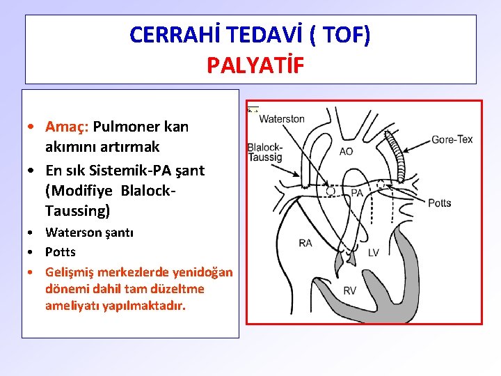 CERRAHİ TEDAVİ ( TOF) PALYATİF • Amaç: Pulmoner kan akımını artırmak • En sık