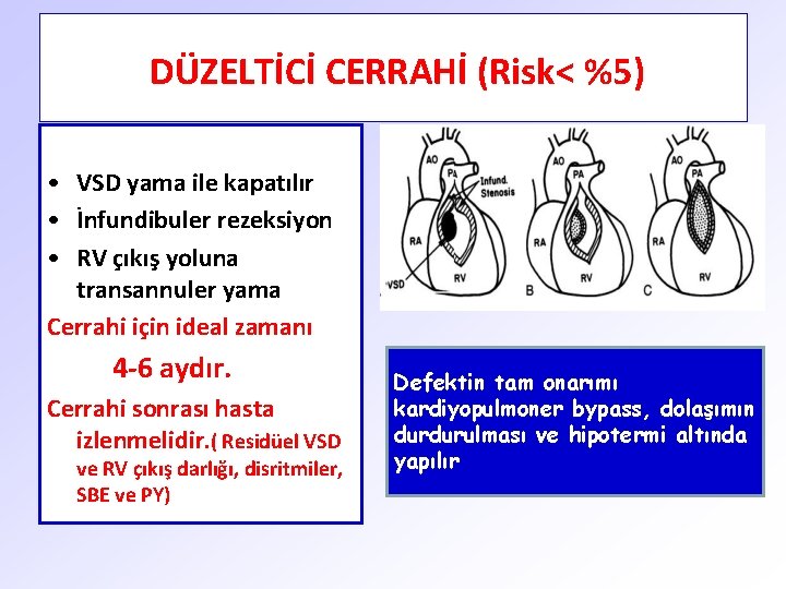 DÜZELTİCİ CERRAHİ (Risk< %5) • VSD yama ile kapatılır • İnfundibuler rezeksiyon • RV