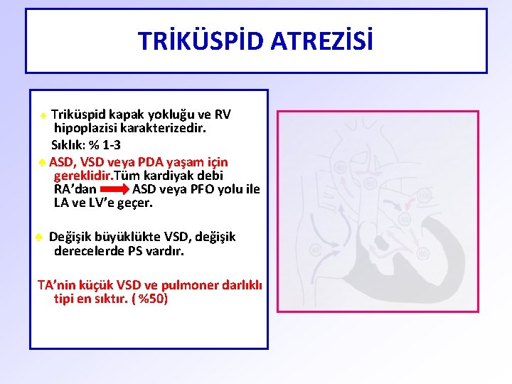 TRİKÜSPİD ATREZİSİ Triküspid kapak yokluğu ve RV hipoplazisi karakterizedir. Sıklık: % 1 -3 ♠