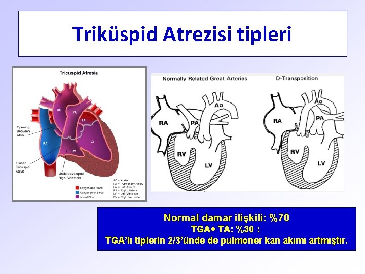 Triküspid Atrezisi tipleri Normal damar ilişkili: %70 TGA+ TA: %30 : TGA’lı tiplerin 2/3’ünde