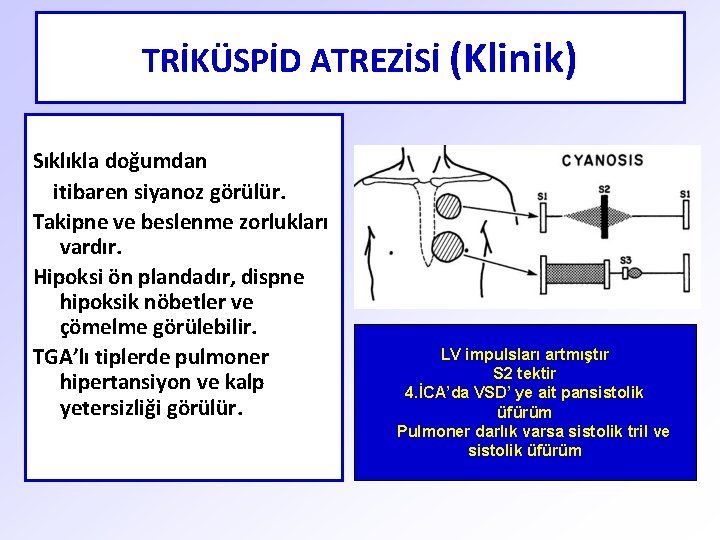 TRİKÜSPİD ATREZİSİ (Klinik) Sıklıkla doğumdan itibaren siyanoz görülür. Takipne ve beslenme zorlukları vardır. Hipoksi