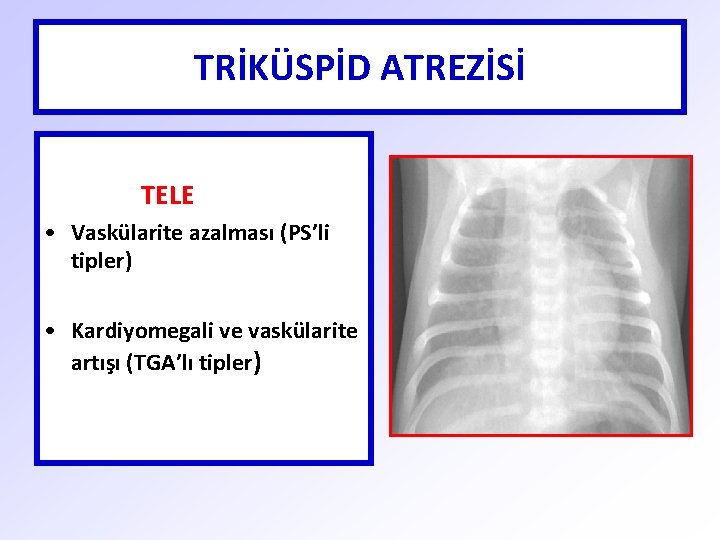 TRİKÜSPİD ATREZİSİ TELE • Vaskülarite azalması (PS’li tipler) • Kardiyomegali ve vaskülarite artışı (TGA’lı