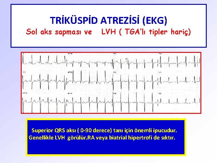 TRİKÜSPİD ATREZİSİ (EKG) Sol aks sapması ve LVH ( TGA’lı tipler hariç) Superior QRS