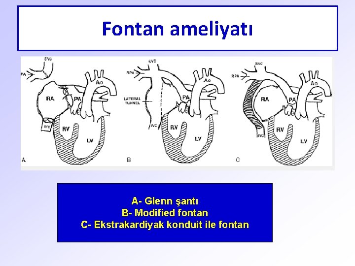 Fontan ameliyatı A- Glenn şantı B- Modified fontan C- Ekstrakardiyak konduit ile fontan 