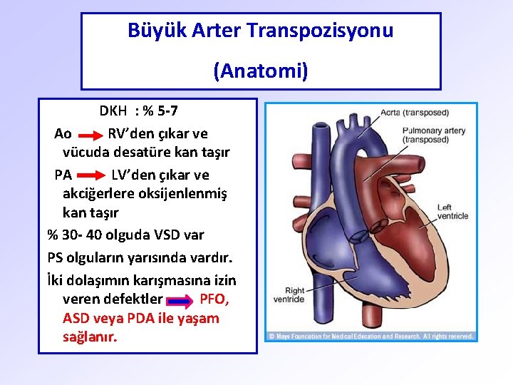 Büyük Arter Transpozisyonu (Anatomi) DKH : % 5 -7 Ao RV’den çıkar ve vücuda