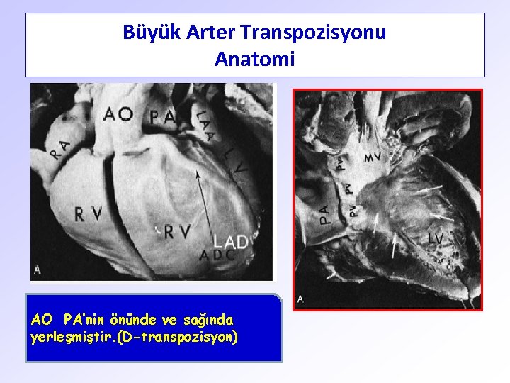 Büyük Arter Transpozisyonu Anatomi AO PA’nin önünde ve sağında yerleşmiştir. (D-transpozisyon) 