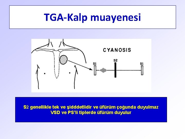 TGA-Kalp muayenesi S 2 genellikle tek ve şidddetlidir ve üfürüm çoğunda duyulmaz VSD ve