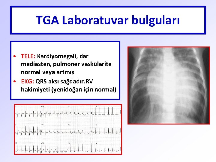 TGA Laboratuvar bulguları • TELE: Kardiyomegali, dar mediasten, pulmoner vaskülarite normal veya artmış •