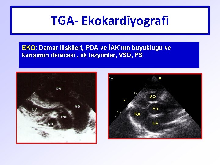 TGA- Ekokardiyografi EKO: Damar ilişkileri, PDA ve İAK’nın büyüklüğü ve karışımın derecesi , ek