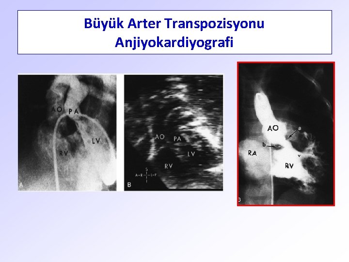 Büyük Arter Transpozisyonu Anjiyokardiyografi 