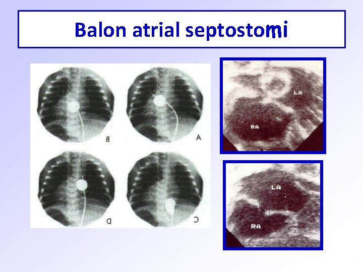 Balon atrial septostomi 