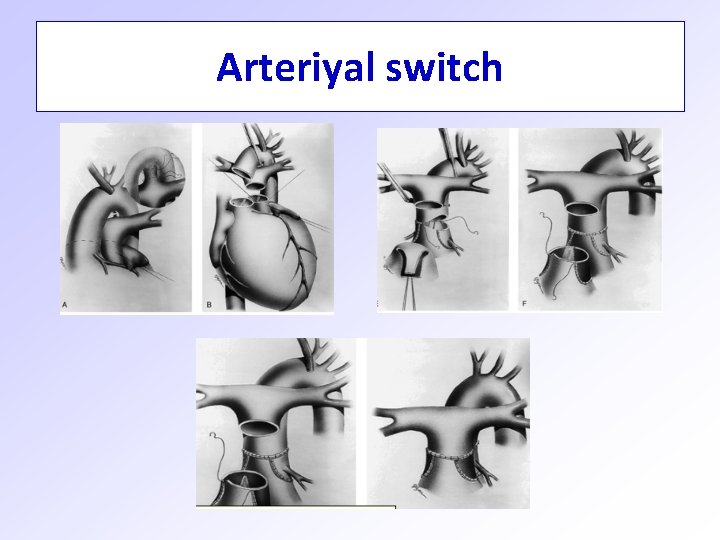 Arteriyal switch 