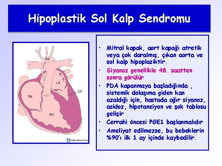 Hipoplastik Sol Kalp Sendromu • Mitral kapak, aort kapağı atretik veya çok daralmış, çıkan