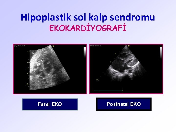 Hipoplastik sol kalp sendromu EKOKARDİYOGRAFİ Fetal EKO Postnatal EKO 