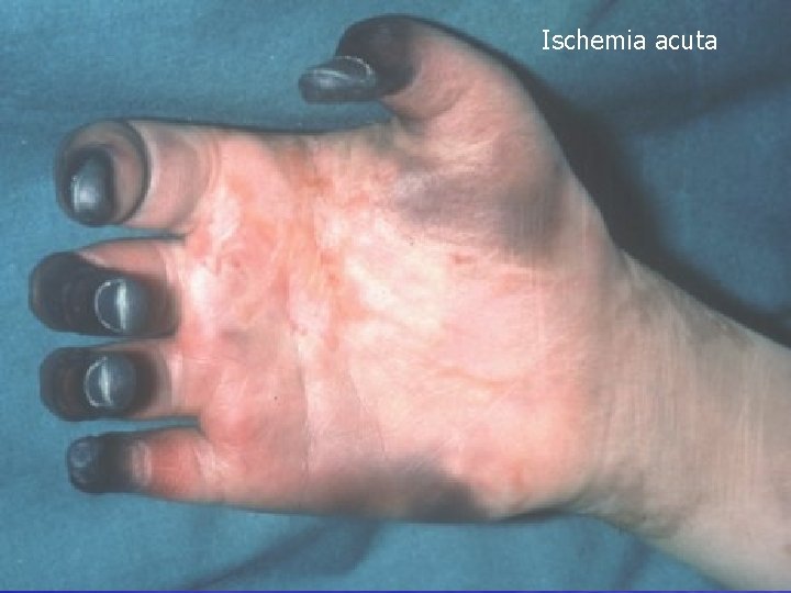 Ischemia acuta Ischemia arteriala acuta periferica - diminuarea cifrelor de termometrie cutanata - scăderea