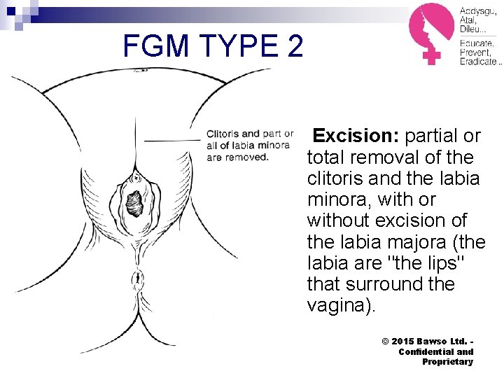 FGM TYPE 2 Excision: partial or total removal of the clitoris and the labia