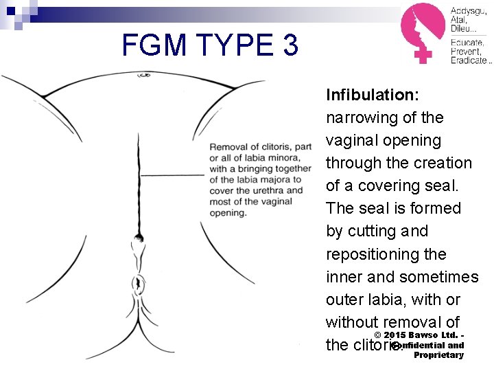 FGM TYPE 3 Infibulation: narrowing of the vaginal opening through the creation of a