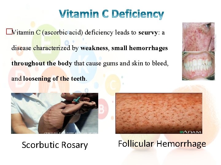 �Vitamin C (ascorbic acid) deficiency leads to scurvy: a disease characterized by weakness, small