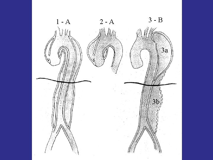 1 -A 2 -A 3 -B 3 a 3 b 1 -A 2 -A 3 -B 3 a 3 b