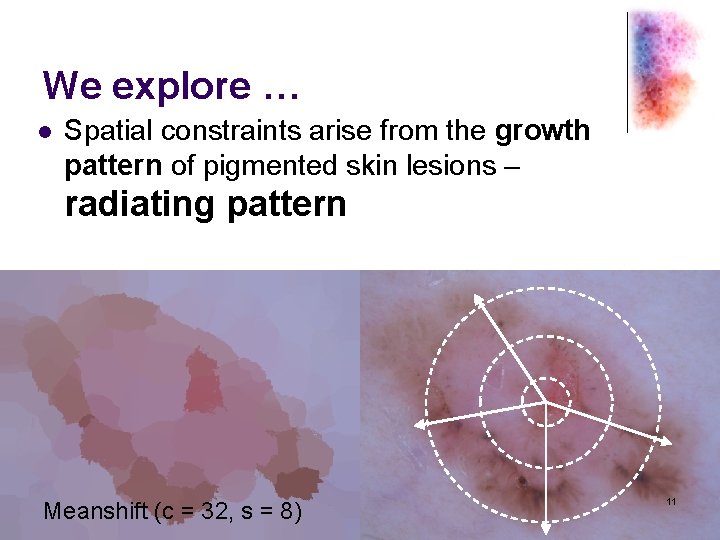 We explore … l Spatial constraints arise from the growth pattern of pigmented skin