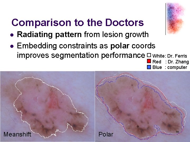 Comparison to the Doctors l l Radiating pattern from lesion growth Embedding constraints as