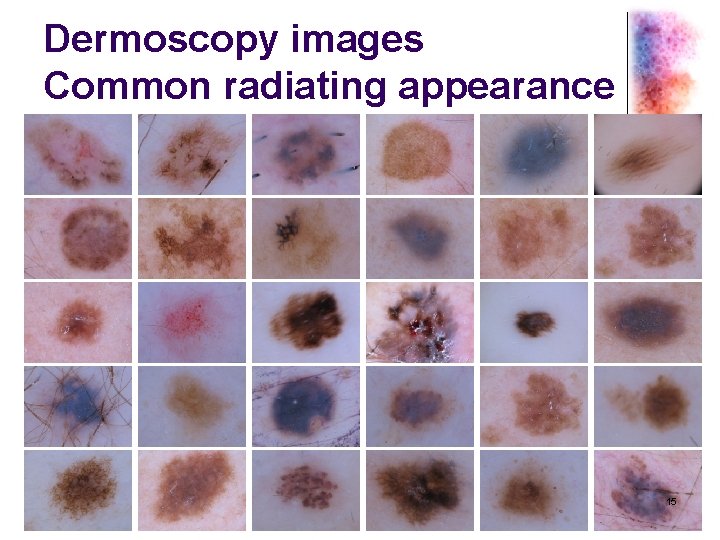 Dermoscopy images Common radiating appearance 15 
