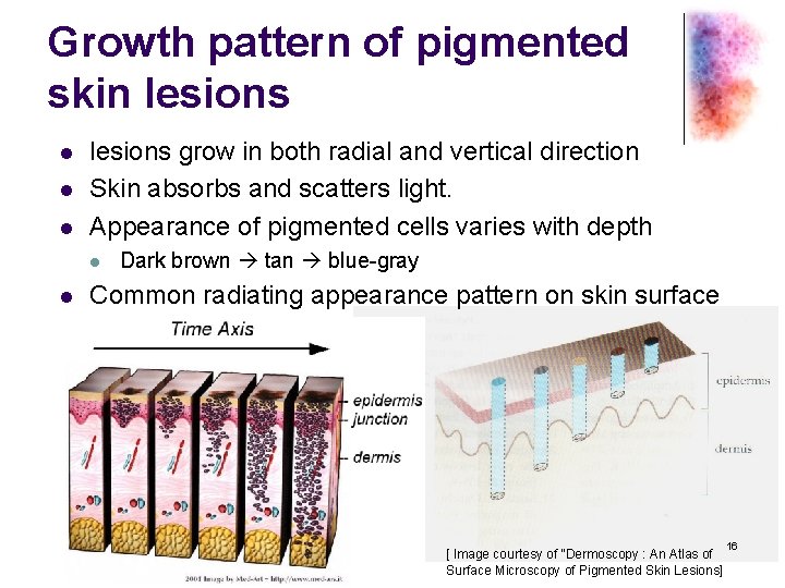 Growth pattern of pigmented skin lesions l lesions grow in both radial and vertical