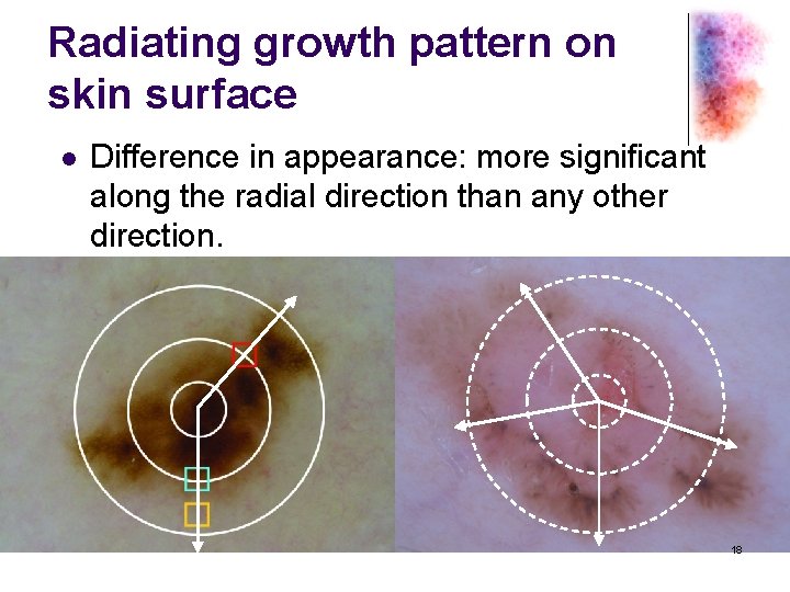 Radiating growth pattern on skin surface l Difference in appearance: more significant along the