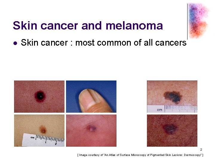 Skin cancer and melanoma l Skin cancer : most common of all cancers 2