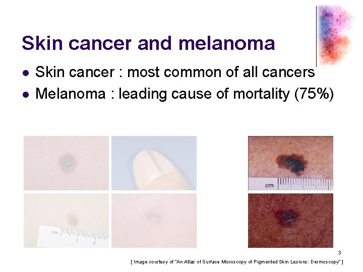 Skin cancer and melanoma l l Skin cancer : most common of all cancers