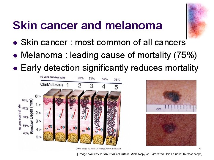 Skin cancer and melanoma l l l Skin cancer : most common of all