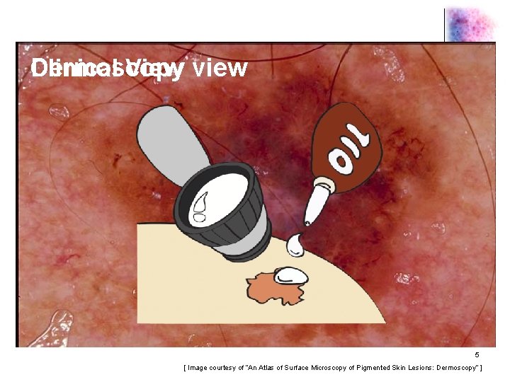 Dermoscopy Clinical View view 5 [ Image courtesy of “An Atlas of Surface Microscopy