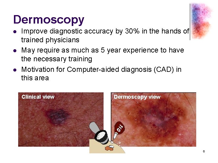 Dermoscopy l l l Improve diagnostic accuracy by 30% in the hands of trained