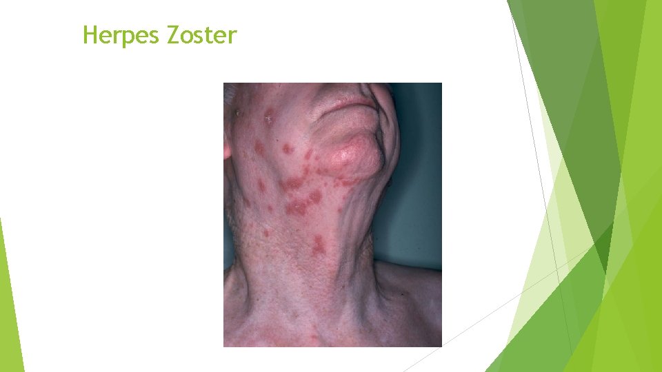 Herpes Zoster 