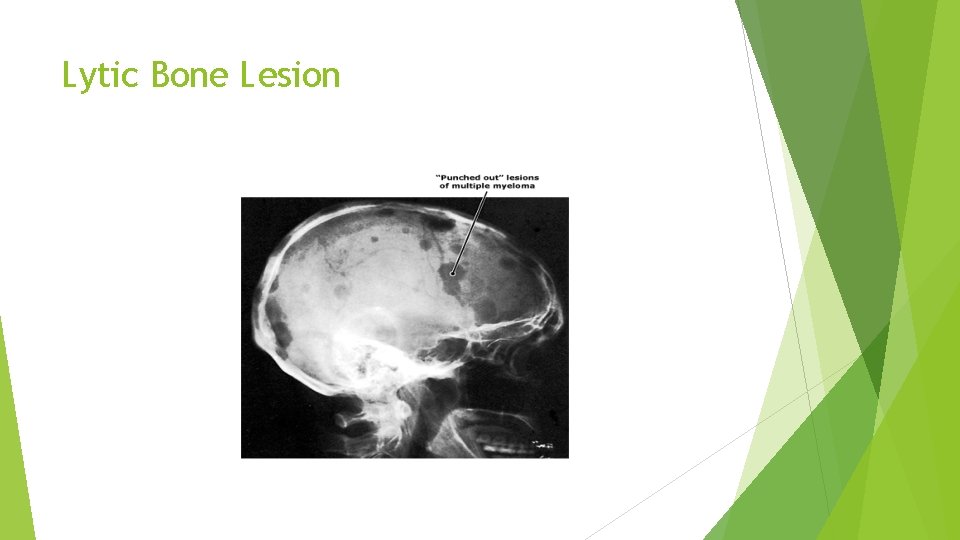 Lytic Bone Lesion 