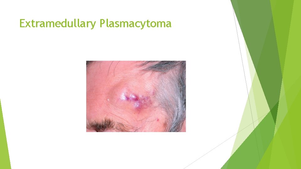 Extramedullary Plasmacytoma 