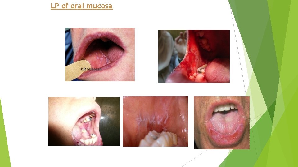 LP of oral mucosa 