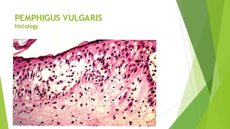 PEMPHIGUS VULGARIS histology 