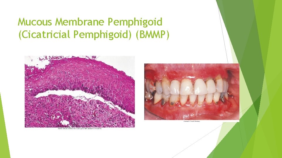 Mucous Membrane Pemphigoid (Cicatricial Pemphigoid) (BMMP) 