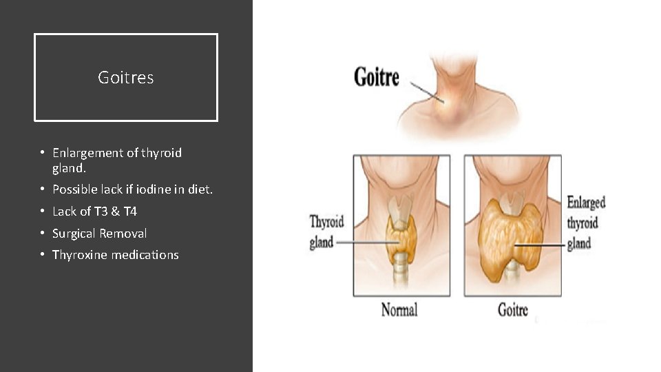 Goitres • Enlargement of thyroid gland. • Possible lack if iodine in diet. •