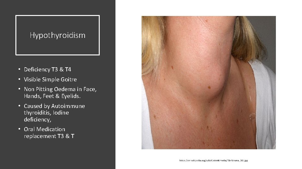 Hypothyroidism • Deficiency T 3 & T 4 • Visible Simple Goitre • Non