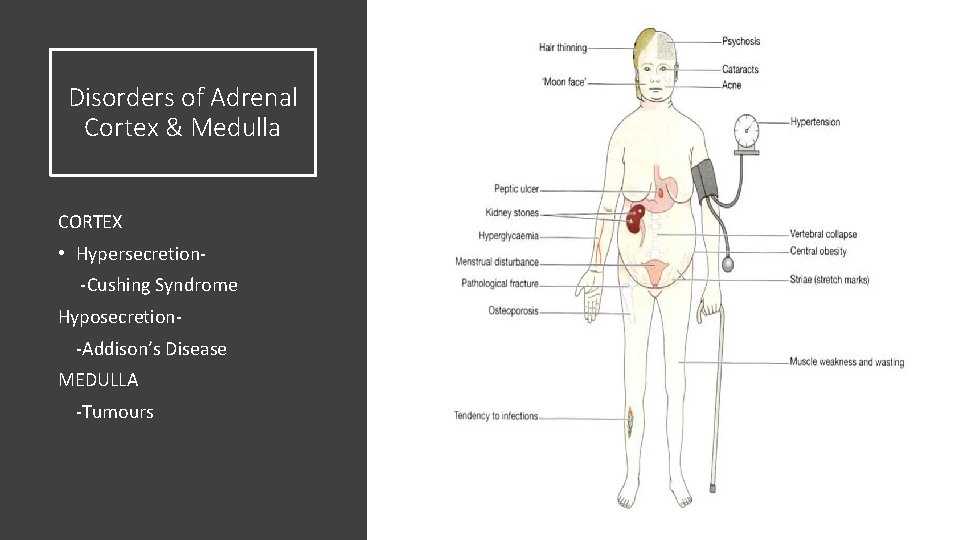 Disorders of Adrenal Cortex & Medulla CORTEX • Hypersecretion-Cushing Syndrome Hyposecretion-Addison’s Disease MEDULLA -Tumours