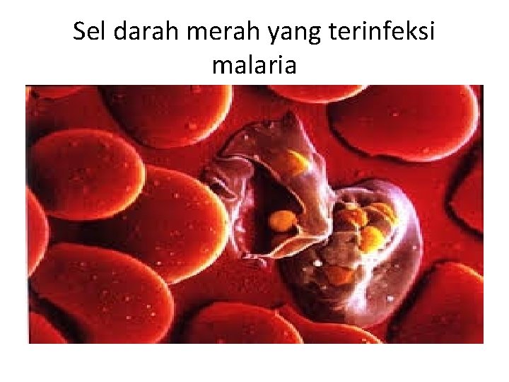 Sel darah merah yang terinfeksi malaria 