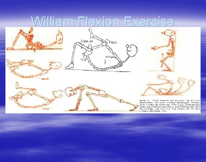 William Flexion Exercise 