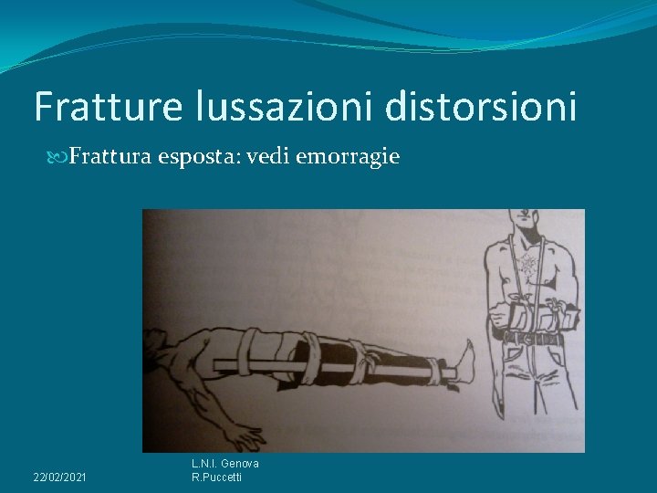 Fratture lussazioni distorsioni Frattura esposta: vedi emorragie 22/02/2021 L. N. I. Genova R. Puccetti